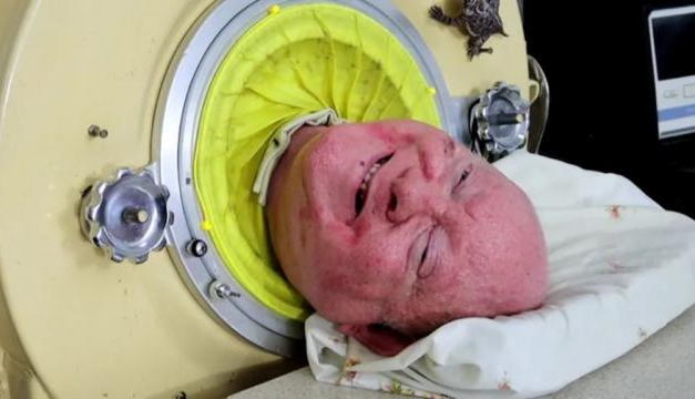 El hombre que vivía en un pulmón de acero, Paul Alexander, murió a los 78 años.